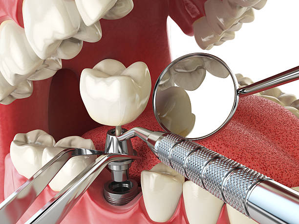Best Emergency Treatment for Dental Infections or Abscesses in Ruch, OR